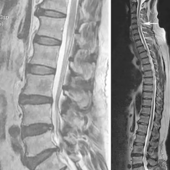 MRI Screening of LS Spine